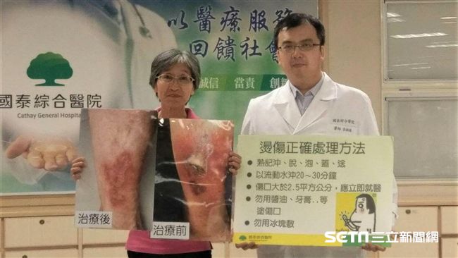 艾草熱敷治痠麻　小腿竟蜂窩性組織炎