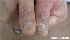 乾癬除了皮膚症狀外，還可能有關節炎、心血管問題等共病發生，患者要有長期抗戰的決心，接受正規治療且至少10年內都要定期追蹤。（圖／中山大學附設醫院皮膚科主任蕭玉屏提供）