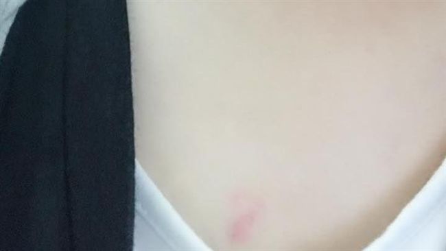 正妹胸口被種草莓　兇手竟被讚可愛