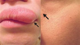 女子臉上有腫塊竟是寄生蟲／nauka（https://goo.gl/5ncPFc）