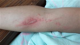 隱翅蟲、被隱翅蟲毒液噴到紅腫／臉書爆廢公社公開版