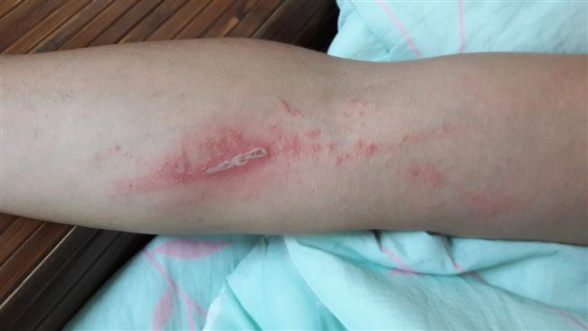 雨後隱翅蟲爆發　打死牠10秒就毀容