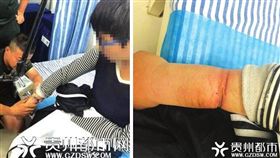 大陸貴州一名14歲少年因為好奇，將一副廢棄手銬銬在右手上，沒想到手銬壞掉開不起來，他整整被銬了1年多才告訴家人，導致他的手腫如「小叮噹」的手臂。所幸少年就醫後，手銬成功被剪斷，沒有大礙。（圖／翻攝自微博）