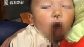 大陸貴州有一名郭姓媽媽，日前用筷子將粽子串起給1歲半的兒子吃，沒想到男童突然倒在地上，25公分的筷子從鼻腔插入眼眶滿臉是血，媽媽當場嚇得腿軟立刻將兒子送醫急救。所幸手術相當成功，男童的視力、眼球活動都沒有損傷。（圖／翻攝自看看新聞）