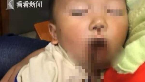 筷子插進嘴巴眼眶　1歲半童滿臉鮮血