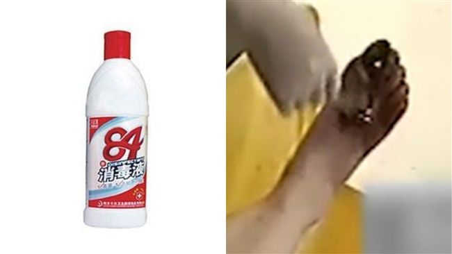 女用這液給媽去腳氣！結果害恐需截趾
