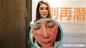 蔡小姐罹患酒糟性皮膚炎，滿臉皮膚泛紅且雙頰遍佈丘疹，最後使用新型藥膏，泛紅程度明顯改善。（圖／記者楊晴雯攝）