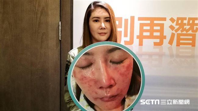 酒糟性皮膚炎　恐「臉蟲太多」害的