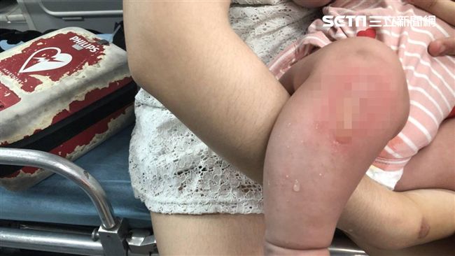 女嬰遭鄰居潑灑不明液體　燒燙傷送醫
