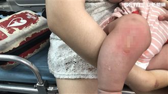 鄰居闖入潑不明液體？　女嬰灼傷送醫