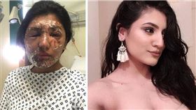 英國,強酸,毀容,植皮,手術,復健,臉,Resham Khan　圖／翻攝自推特