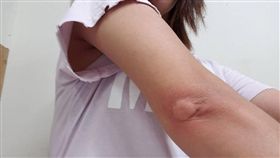 蚊子,手肘,紅腫,乒乓球,爆怨公社,就醫,過敏（圖／翻攝自《爆怨公社》臉書）