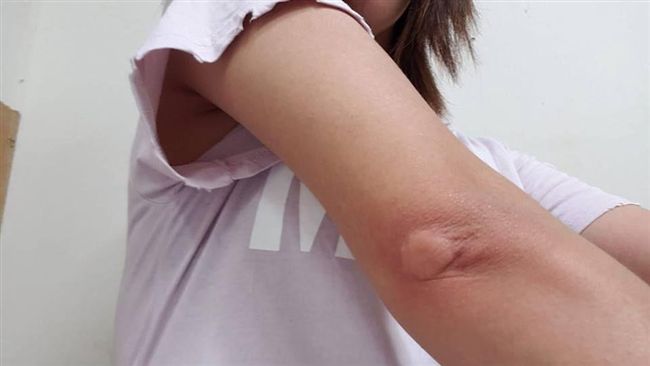 被蚊子吸飽吸滿　她手肘腫成乒乓球