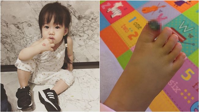 六月女兒遭砸傷　傷口嚴重全黑惹人疼