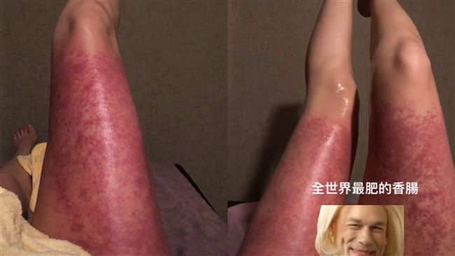 密集恐懼慎入！女星嫩腿慘爬滿凸起物