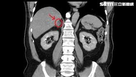 安南醫院,泌尿科,林育緯,腎上腺腫瘤,病人,高血壓,血壓
圖／安南醫院
