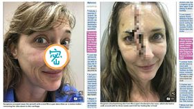 美國女子不塗防曬乳鼻子上燒出凹洞,皮膚癌（圖／翻攝自每日郵報）
http://www.dailymail.co.uk/health/article-5899799/Tanning-addict-enjoys-burnt-discovered-pimple-nose-turned-skin-cancer.html
