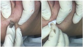 粉刺,痘痘,做臉,療癒／Bùn Cứu Dưỡng Sinh臉書粉專