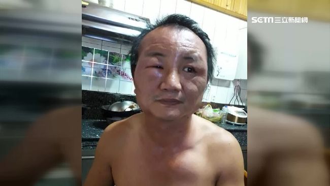網購染髮劑過敏　男腫成豬頭求償無門
