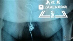 ▲電線在男童膀胱內打了死結（圖／翻攝自新浪網）