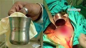 印度,肛門,鋼杯(圖/翻攝自都會報