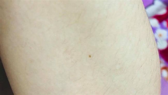 筆芯卡在手臂內7年　他PO照掀共鳴