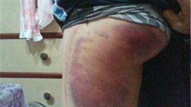 虐童,紫大腿,家暴,驗傷,提告,爆料公社, （圖／翻攝爆料公社）