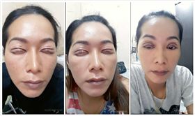 ▲手術失敗變三眼皮。（圖／翻攝自ดอกจิก v.5臉書） 