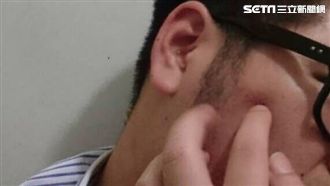 蟲在皮膚挖隧道產卵！一人中鏢全家遭殃