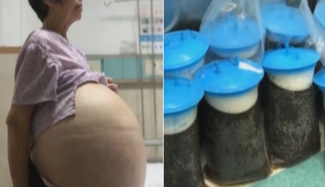 5年巨胎險奪命　婦抽33升囊液保命
