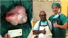 林孝祖到巴布亞紐幾內亞義診，開刀取出「半公尺超大卵巢瘤」（圖／翻攝自林孝祖醫師臉書）打碼版