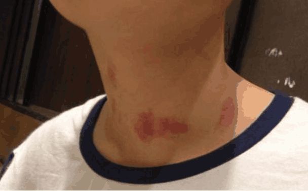 13歲童被轉大人　媽見滿脖吻痕嚇傻