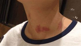 吻痕,女友,中風,種草莓,血栓

圖／翻攝自北京時間