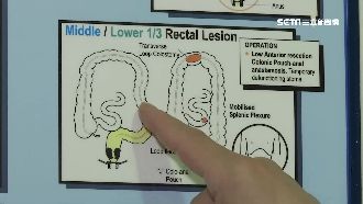 大腸癌轉移案例多　醫曝延長壽命關鍵