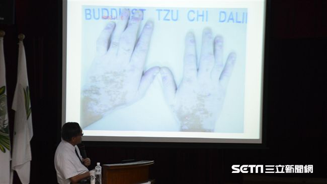 白斑不再沒藥醫　9成5能得到控制