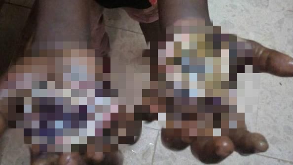 偷東西被逮　8歲女童遭父親火烤毒打