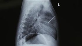 大陸,福建,釘槍,鋼釘,命危(圖/翻攝自微博)