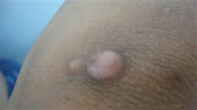 手肘長肉瘤。（圖／翻攝自百度）