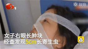 大陸女子右眼取出5公分寄生蟲。（圖／翻攝自秒拍）