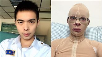 獨／役男幫救災遇氣爆　帥氣臉龐毀容
