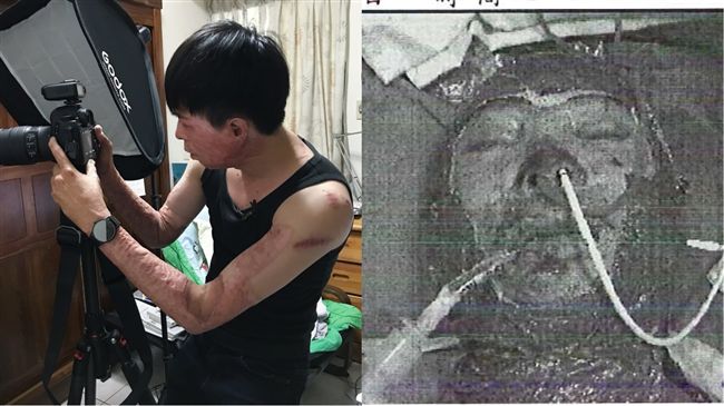 「我無法救他」毀容替代役揭沉痛噩夢