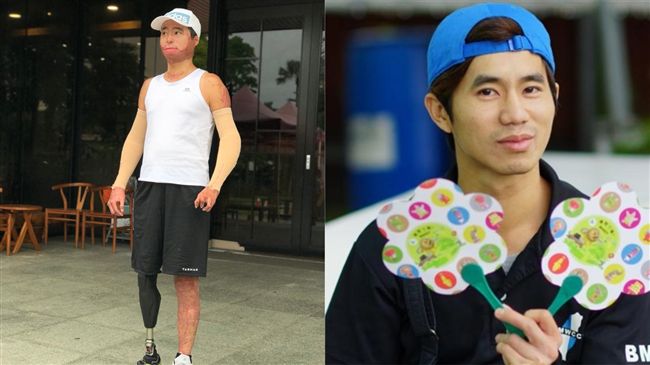 「我女兒還小」他毀容截肢　奇蹟甦醒