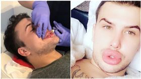 英國,整形,豐唇,爆炸,填充物,（圖／翻攝自James Holt Instagram）