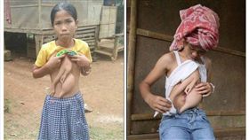 ▲少女胸前長「一雙手」將赴泰做切除。（圖／翻攝自泰國網臉書） 