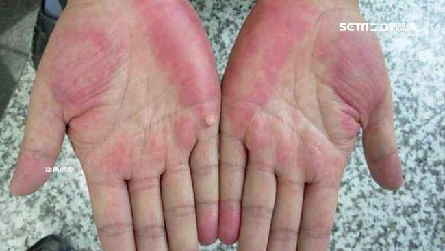 手掌兩側泛紅　3警訊小心「肝」！