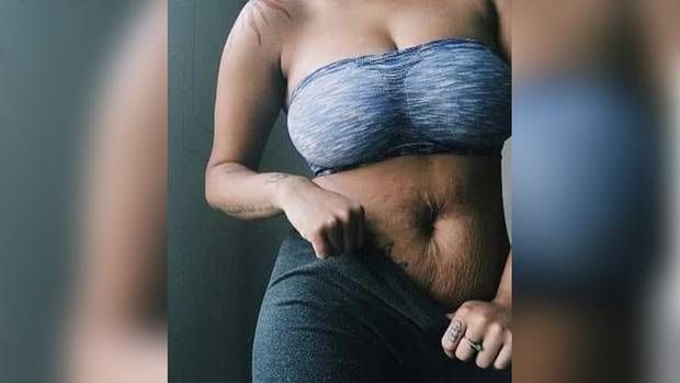 婦人PO妊娠紋照　遭酸像「犀牛皮」
