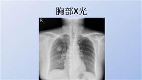 十大死因,惡性腫瘤,腫瘤,肺癌,安南醫院,胸腔科,林延淞,胸部超音波