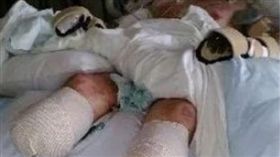 格雷格四肢截肢。（圖／翻攝自twincities.com） https://goo.gl/F7gJ4n