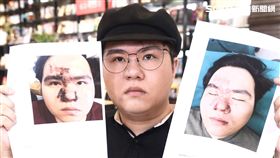 冒牌生秀出毀容照，相當嚇人。（圖／記者蔡世偉攝影）