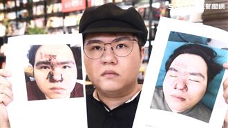 網紅整容失右眼　一覺醒來怕都看不見